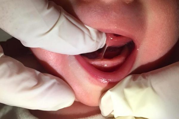 Frenulo linguale corto neonato